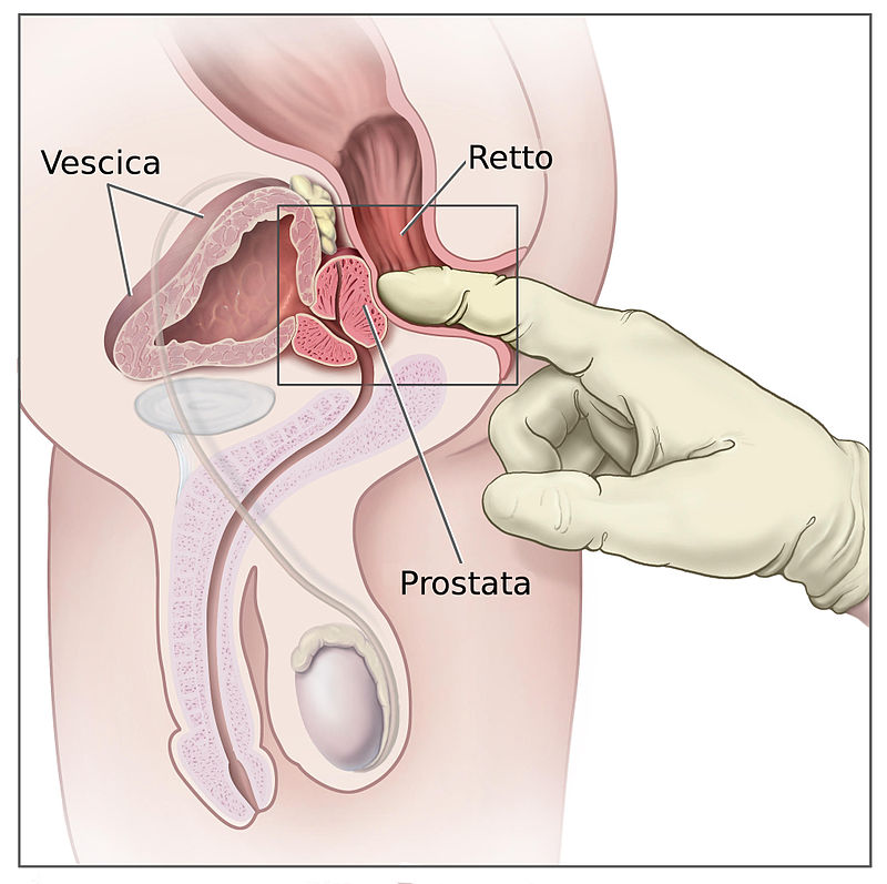 prostata ingrossata misure