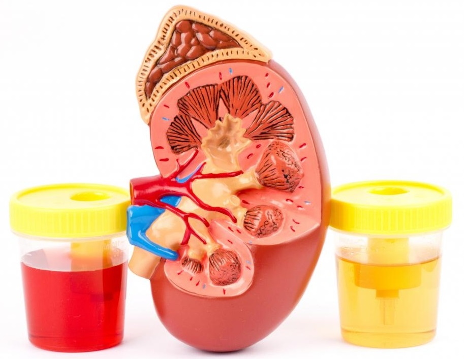 Ematuria o tracce di sangue nelle urine: cosa fare
