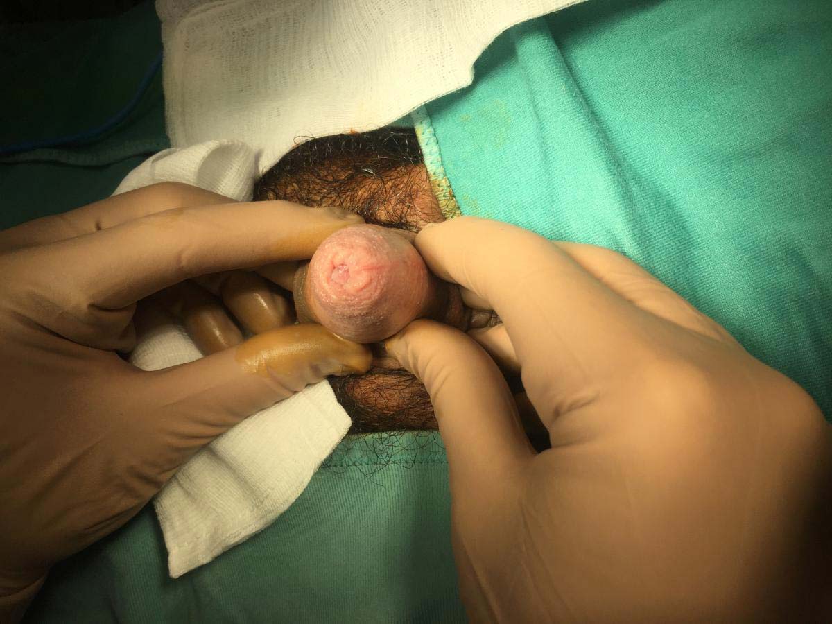 Fimosi congenita o acquisita