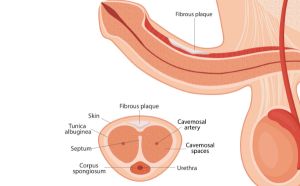 Malattia di Peyronie e l'iniezione di Xiapex