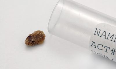 calcoli e calcolosi