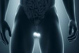 Varicocele