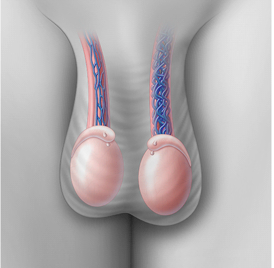 Varicocele