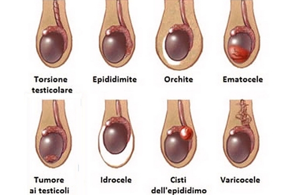 cause dolore testicolare