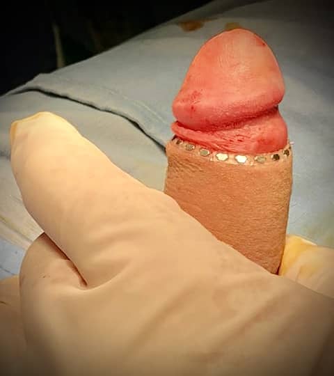 Intervento di circoncisione con tecnica innovativa  indolore