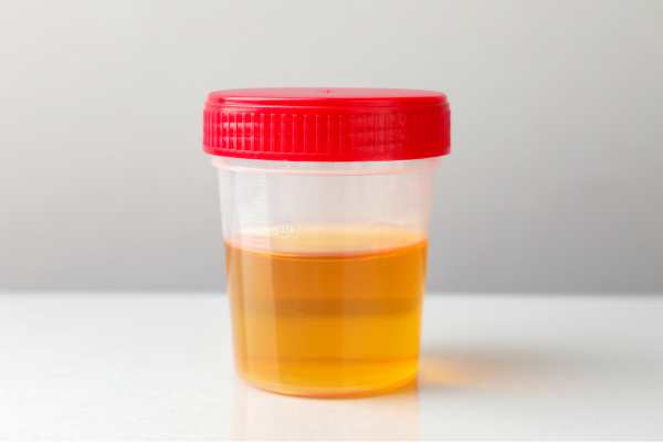 Colore delle urine