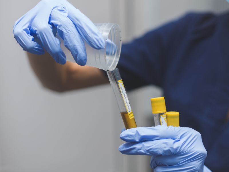esame delle urine per la diagnosi della prostata ingrossata