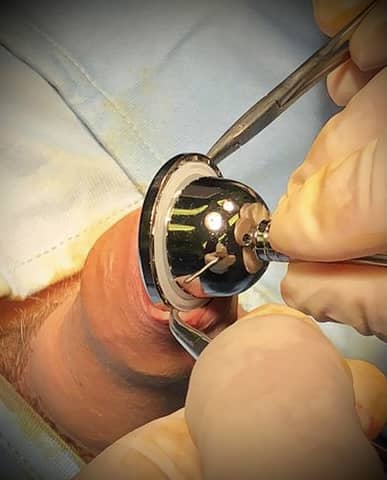 Circoncisione maschile la tecnica 