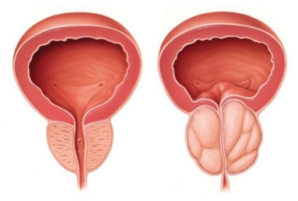 iperplasia prostatica benigna