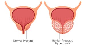 Ipertrofia Prostatica