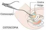 Cistoscopia a cosa serve