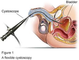 Cistoscopia urinaria