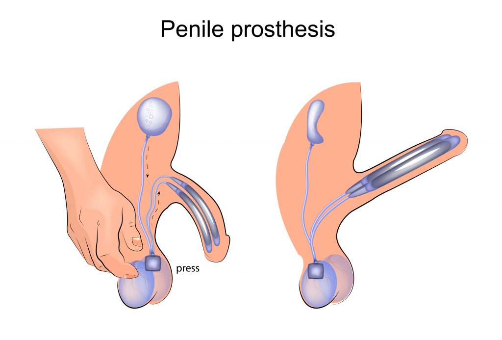 Protesi peniena