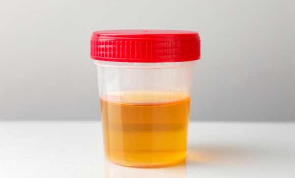 Colore delle urine