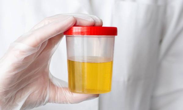 leucociti nelle urine