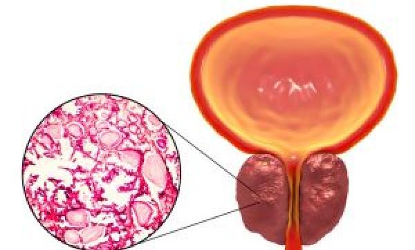 Iperplasia Prostatica Benigna: come curare la prostata ingrossata