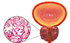 Iperplasia Prostatica Benigna: come curare la prostata ingrossata