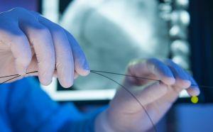 stent ureterale