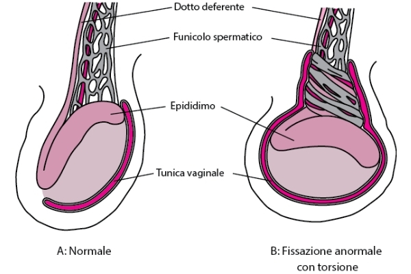 torsione testicolare