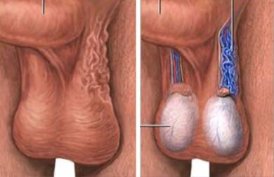 Varicocele