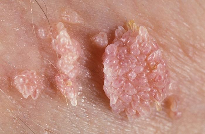 Papilloma virus verruche genitali femminili. Zentel pt oxiuri